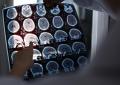 Alzheimer, ok Ue a nuovo farmaco per trattare fasi iniziali malattia