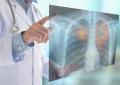 Tumori, nel 2050 i morti cancro supereranno i 18 milioni (+75%): lo studio su Lancet