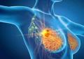 Cancro seno iniziale Her2+, con anticorpo farmaco-coniugato -53% recidiva
