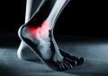 Ossa fragili dei calciatori, ecco perché post ritiro tanti soffrono di osteoartrite