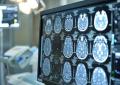 Neoplasie cerebrali, in Italia ogni anno 3mila casi di glioma