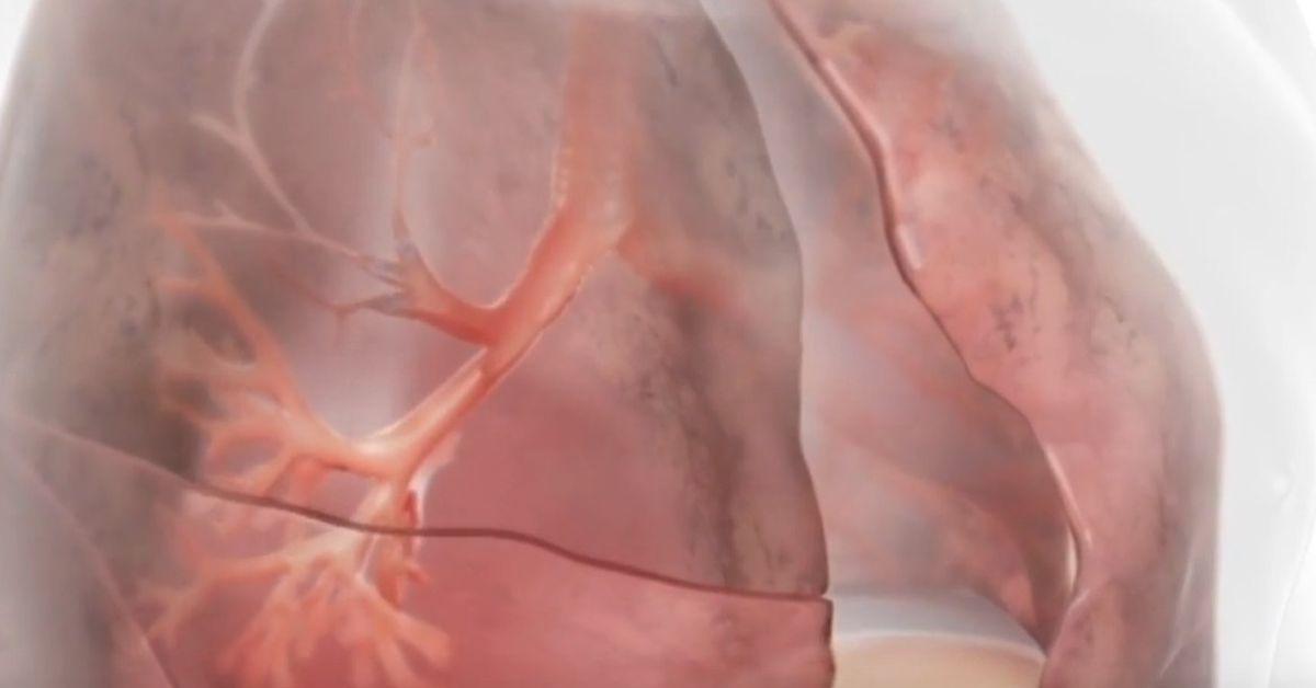 Innovazioni terapeutiche nella BPCO con enfisema