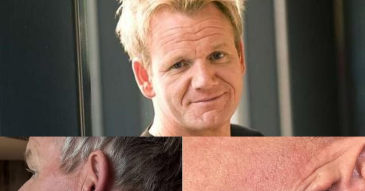 lo chef gordon ramsay operato per cancro alla pelle rimosso un carcinoma basocellulare non ho fatto il lifting