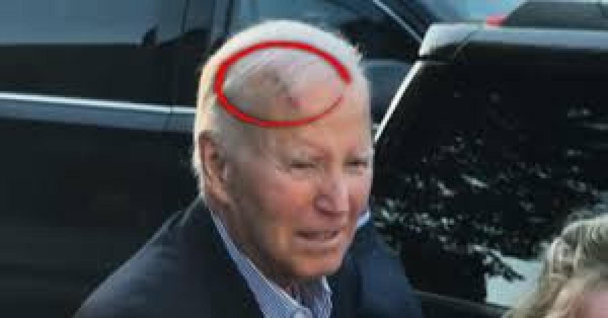 Joe Biden operato per asportare un tumore alla pelle sulla testa, a maggio la diagnosi di un cancro avanzato alla prostata con metastasi ossee Joe Biden operato per asportare un tumore alla pelle sulla testa, a maggio la diagnosi di un cancro avanzato alla prostata con metastasi ossee