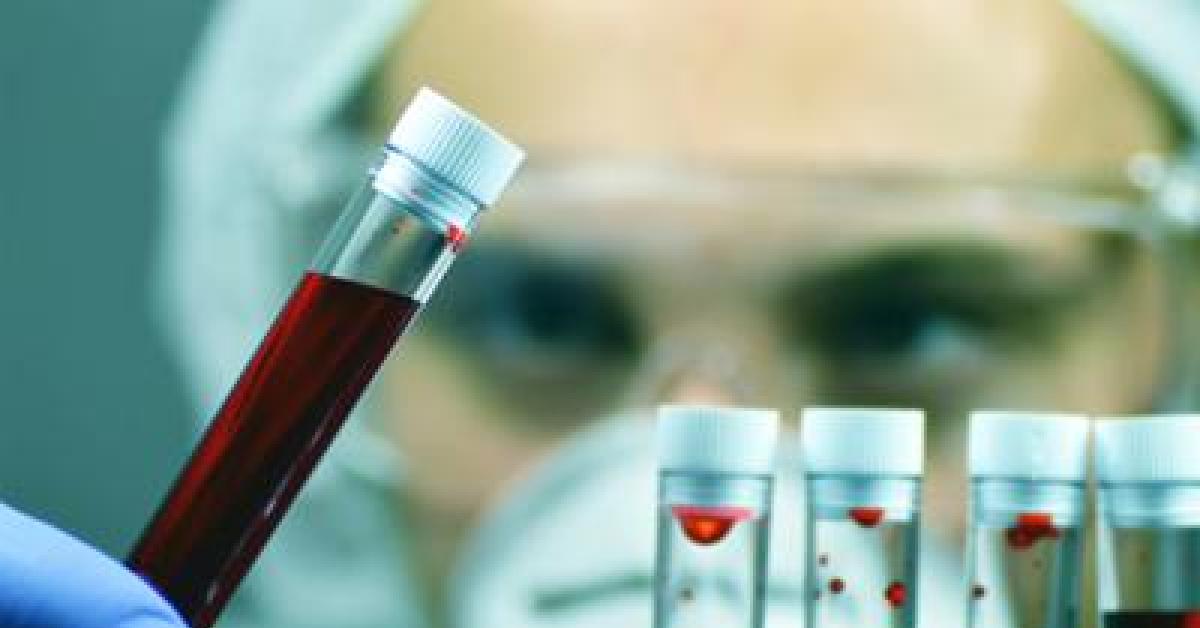alzheimer allo studio esame del sangue per aiutare diagnosi precoce