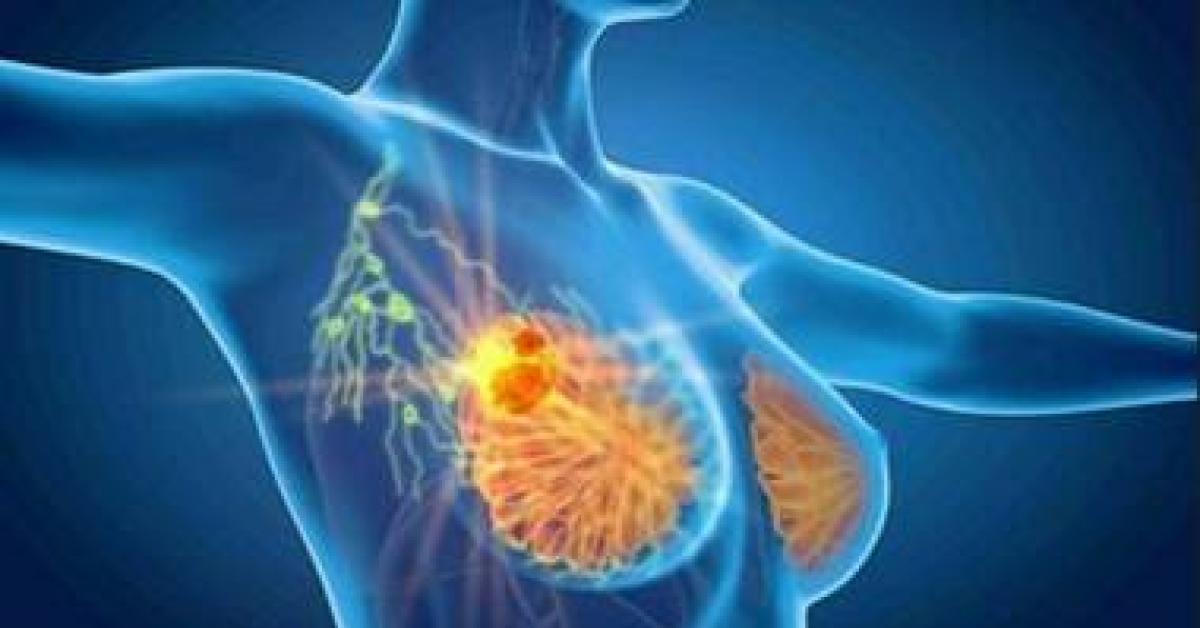 Cancro seno iniziale Her2+, con anticorpo farmaco coniugato 53% recidiva Cancro seno iniziale Her2+, con anticorpo farmaco coniugato 53% recidiva
