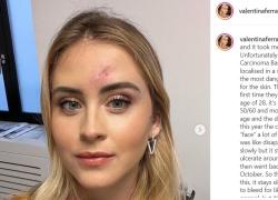 Valentina Ferragni confessa: "Non era un brufolo ma un tumore maligno"
