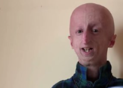Sammy Basso come sta oggi: Instagram e ultima intervista del malato di progeria più longevo 