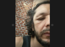Ermal Meta gonfio in faccia: tutte le FOTO e il messaggio