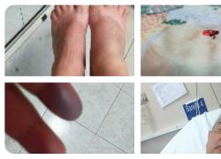 Vaccino Covid, effetti avversi su Raffaele: “Mani e piedi gonfie, dita nere, sangue nelle urine e infarto dopo 3 mesi”