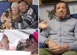 Vinicio Riva, morto l'uomo abbracciato dal Papa col volto deturpato, era affetto dal morbo di von Recklinghausen