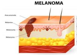 Più melanomi e la ricetta qual è? Più vaccini a rMNA. Che hanno originato i melanomi