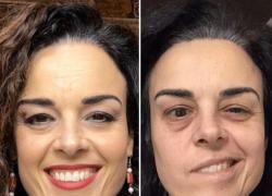 Vaccino Covid, Emilia Padovano invalida e con paralisi di Bell dopo 2 dosi Pfizer, riconosciuto nesso di causa ma nessun indennizzo dallo Stato