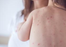 Usa, l'allarmismo sul morbillo nei bambini", 376 casi nel 2025 vs 98 del 2024 nello stesso periodo, ma su 350 mln di abitanti, Kennedy Jr: "Non è inusuale, ci sono epidemie ogni anno"