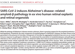 Vaccino Covid, proteina Spike causa Alzheimer, induce formazione amiloide-β, principale componente placche amiloidi responsabili della malattia - lo STUDIO Usa