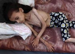 Gaza, continua la carestia causata da Israele, ministero Salute palestinese: "303 morti per fame dal 7 ottobre, 117 i bambini, 3 decessi in 24 ore"