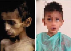 Verona, dimesso Osama Al-raqab, il bimbo di 5 anni di Gaza che pesava 9 kg, simbolo della grave malnutrizione in corso nella Striscia