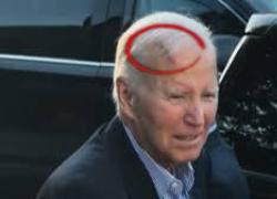 Joe Biden operato per asportare un tumore alla pelle sulla testa, a maggio la diagnosi di un cancro avanzato alla prostata con metastasi ossee