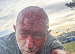 Attentato Sydney, sul posto Arsen Ostrovosky &ldquo;usato da Israele per propaganda&rdquo;, pubblicate foto con volto insanguinato, presente anche il 7 ottobre