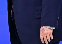 WEF Davos 2026, Trump fotografato con livido e decolorazione su mano sinistra, tycoon minimizza: "L'ho sbattuta sul tavolo, effetto dell'aspirina"
