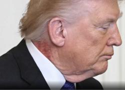 Trump con macchia rossa su collo sotto orecchio dx, ipotesi fuoco di Sant&rsquo;Antonio, medico Barbabella minimizza: &ldquo;Eruzione cutanea&rdquo;