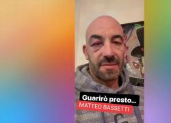 Bassetti ha un occhio nero, l’infettivologo sui social: "incidente a paddle"; agli haters: "soliti stupidi augurano che succeda anche all’altro" - VIDEO
