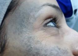 Nevo di Ota sull'occhio, cos'&egrave;: cura, sintomi, rimozione, tumore, nei bambini