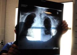 Tumore al polmone: sintomi, prevenzione, fattori di rischio, sopravvivenza
