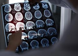 Alzheimer, ok Ue a nuovo farmaco per trattare fasi iniziali malattia