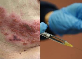 Vaccino Covid a mRNA, trovata correlazione tra fuoco di sant'antonio e inoculazione siero, proteina spike codificata