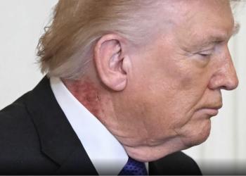 Trump con macchia rossa su collo sotto orecchio dx, ipotesi fuoco di Sant&rsquo;Antonio, medico Barbabella minimizza: &ldquo;Eruzione cutanea&rdquo;
