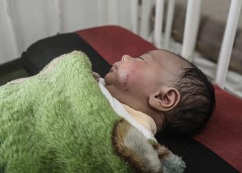 Gaza, rifugio insicuro: un morso di ratto rivela le drammatiche condizioni di vita dei bambini sfollati nella Striscia