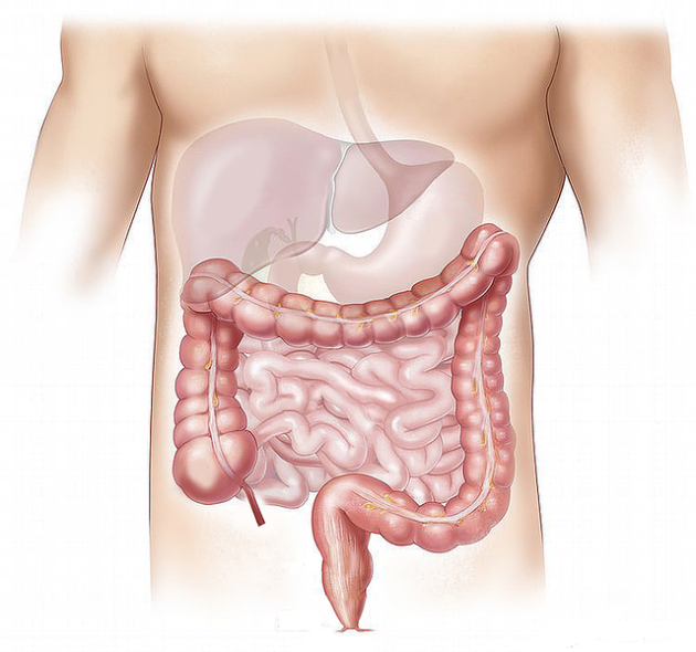 Tumore al colon, scoperto meccanismo alla base delle metastasi