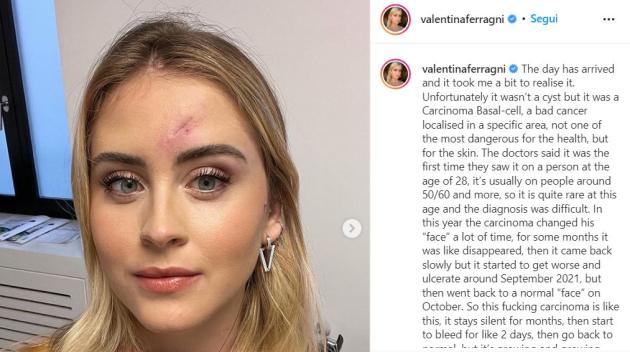 Valentina Ferragni confessa: "Non era un brufolo ma un tumore maligno"