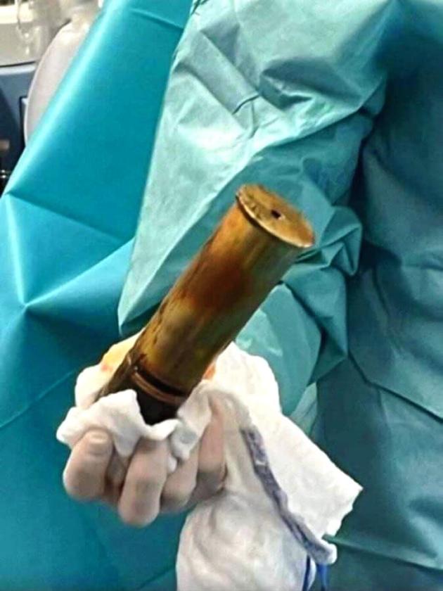 Ordigno incastrato nel retto, 88enne fa scattare l'allarme bomba: evacuato parzialmente ospedale di Tolone