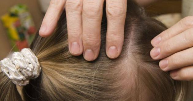 Mamma vegana non vuole uccidere i pidocchi della figlia: "La pettino in giardino, cos&igrave; vivono, il web: "Alleva pure il verme solitario?"