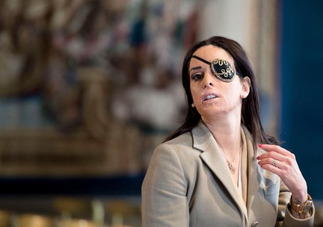 Gessica Notaro, l'occhio sinistro tornerà a vedere: "Farò un trapianto di cornea, sono una miracolata"