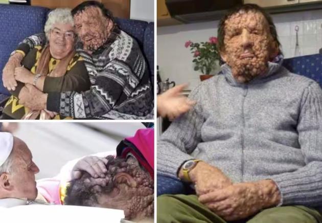 Vinicio Riva, morto l'uomo abbracciato dal Papa col volto deturpato, era affetto dal morbo di von Recklinghausen