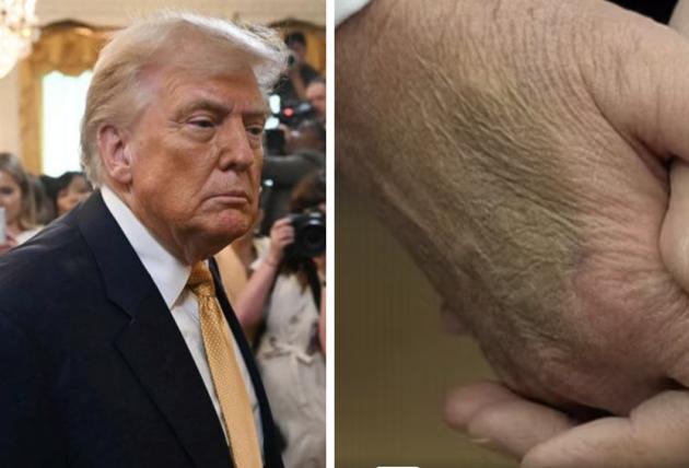 Usa, Trump “malato di Trombosi e Alzheimer”, ma Casa Bianca sminuisce: “Ha solo un’insufficienza venosa cronica, comune negli over 70”