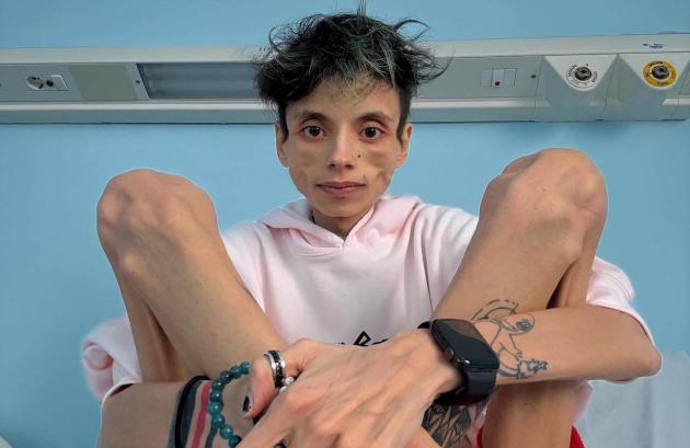 Addio a Thiago Elar, morto a 27 anni il tiktoker transgender ricoverato da mesi per problemi psichiatrici e alimentari