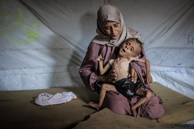 Gaza, Muhammad Zakariya Ayyoub al-Matouq ridotto a pelle e ossa causa carestia: ha 1 anno e mezzo e pesa 6kg, come un bambino di 3 mesi