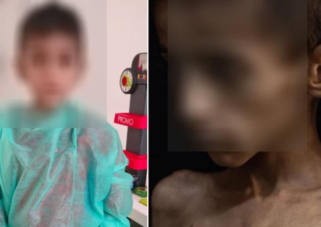 Gaza, il bambino di 5 anni simbolo della fame Osama al-Raqab è stato portato in Italia ed è salvo, in cura all'AUOI di Verona