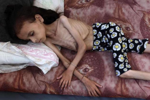Gaza, continua la carestia causata da Israele, ministero Salute palestinese: "303 morti per fame dal 7 ottobre, 117 i bambini, 3 decessi in 24 ore"