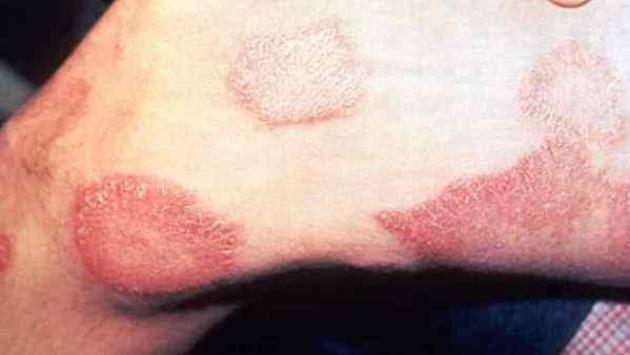 Romania, dopo 44 anni torna la lebbra, diagnosticata ad una massaggiatrice asiatica, un caso anche in Croazia, governo: "Nessun rischio"