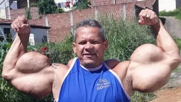 Addio ad Arlindo de Souza &ldquo;Anomalia&rdquo;, morto a 55 anni per insufficienza renale e liquido nei polmoni il bodybuilder dai muscoli con Synthol