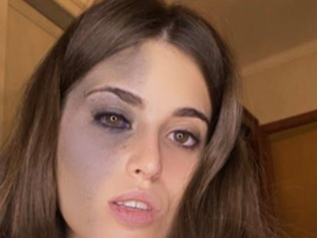 Chi &egrave; Carlotta Bertotti: malattia, voglia sul volto, fidanzato, figli, et&agrave; e carriera