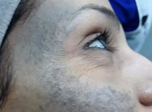 Nevo di Ota sull'occhio, cos'&egrave;: cura, sintomi, rimozione, tumore, nei bambini