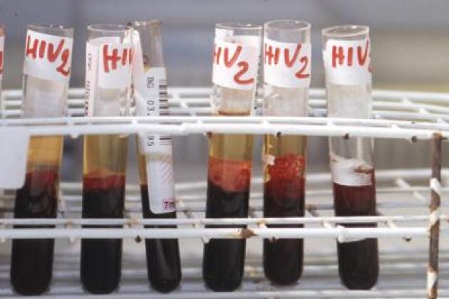 Allarme diagnosi tardive, 'fino a 10 anni con Hiv senza saperlo'