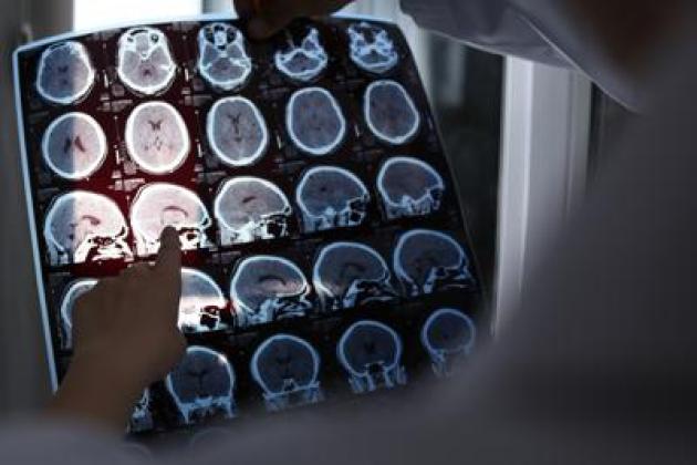 Nuove molecole e bersagli, così si evolve la terapia contro l'Alzheimer: il punto