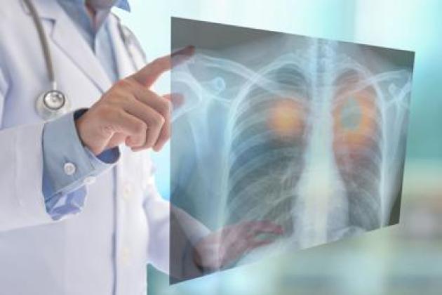 Tumori, nel 2050 i morti cancro supereranno i 18 milioni (+75%): lo studio su Lancet